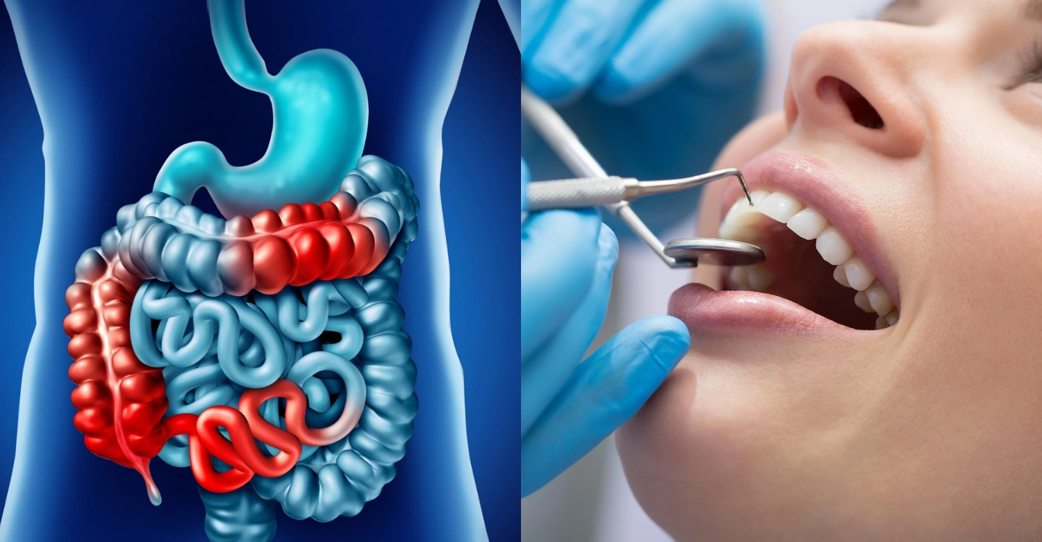 Crohn's disease and periodontal disease inblog